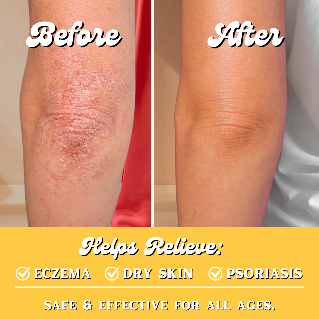Before and after comparison of am elbow with eczema, dry skin, and psoriasis relief.