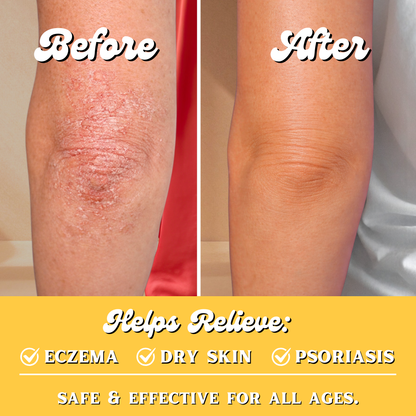 Before and after comparison of am elbow with eczema, dry skin, and psoriasis relief.